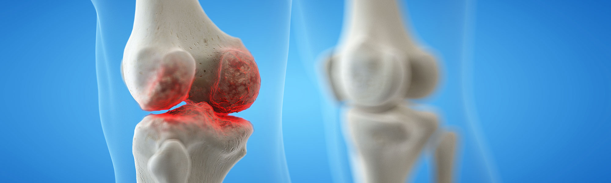 3d rendered medically accurate illustration of an arthritic knee joint