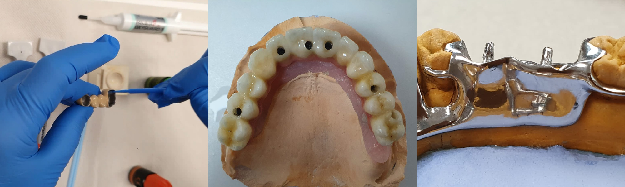 Three pictures showing the process of tooth rehabilitation