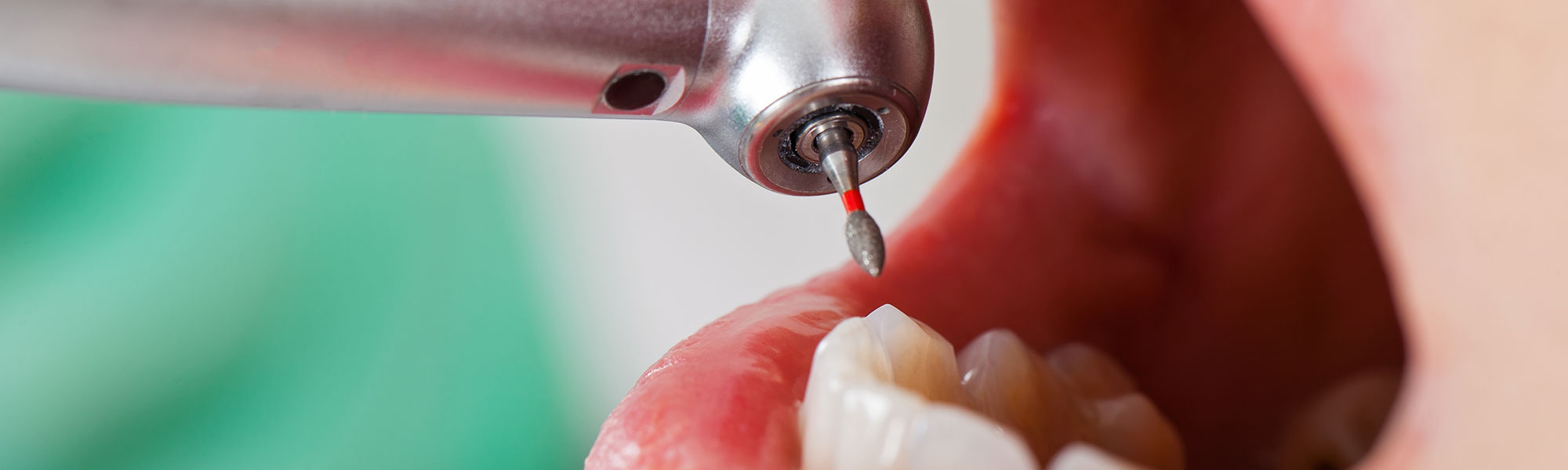 A picture of a dental power tool near a patient's teeth